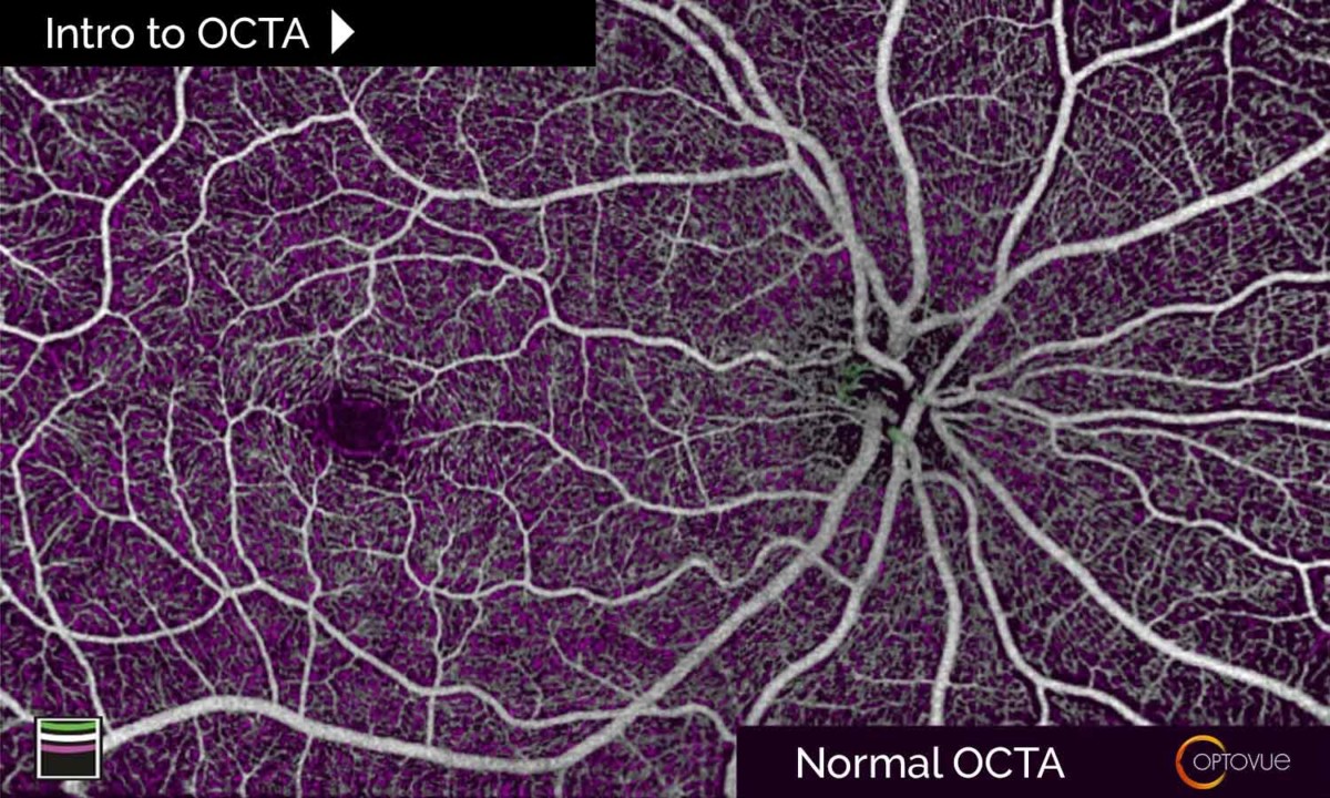 retina oct